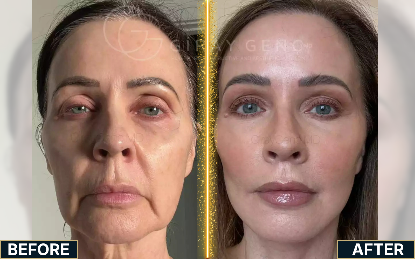 Facelift & Neck Lift before and after result case 02