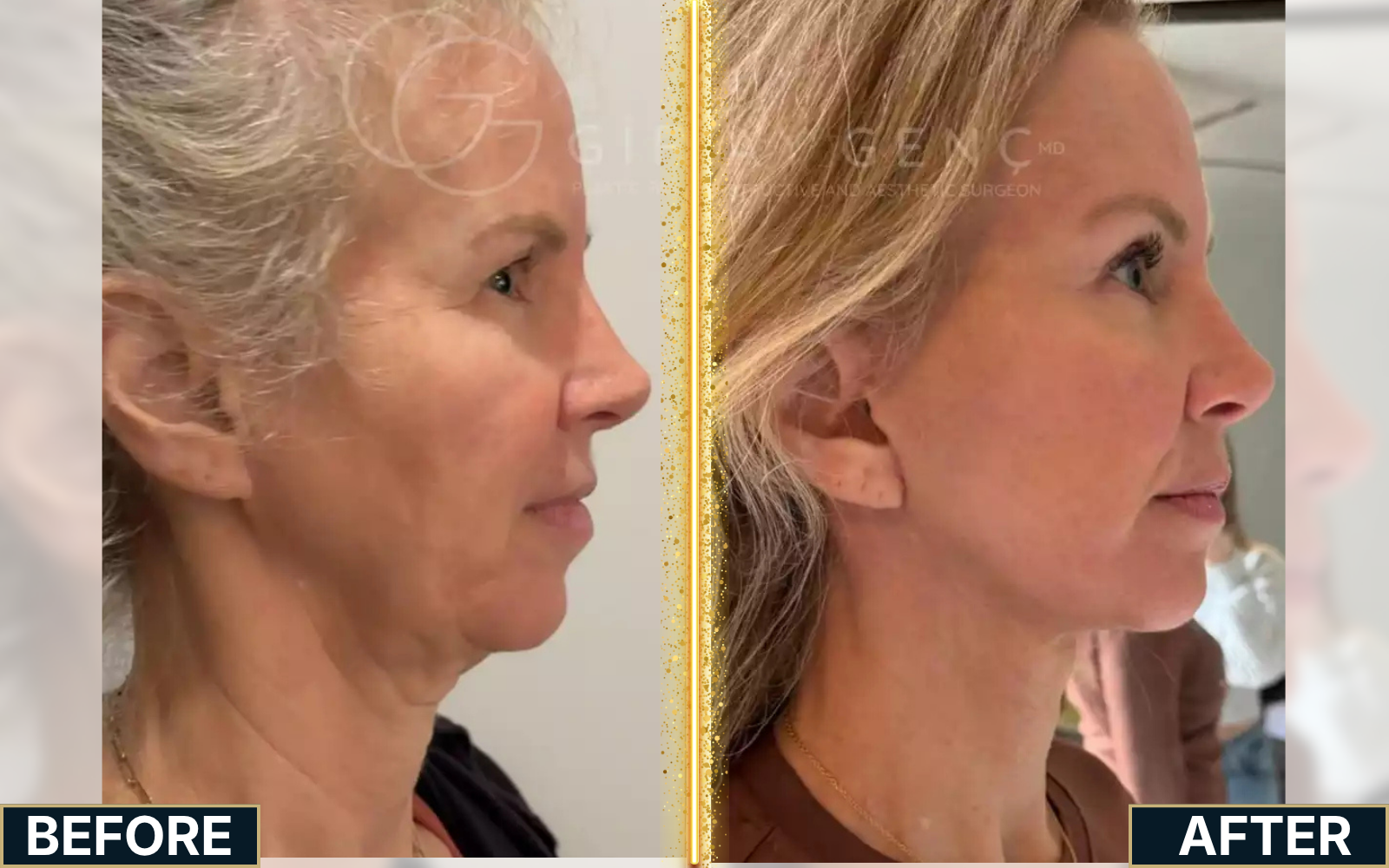 Facelift & Neck Lift before and after result case 03